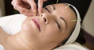 Acupuncture Melbourne – Natural Pain Relief With Traditional Chinese Medicine