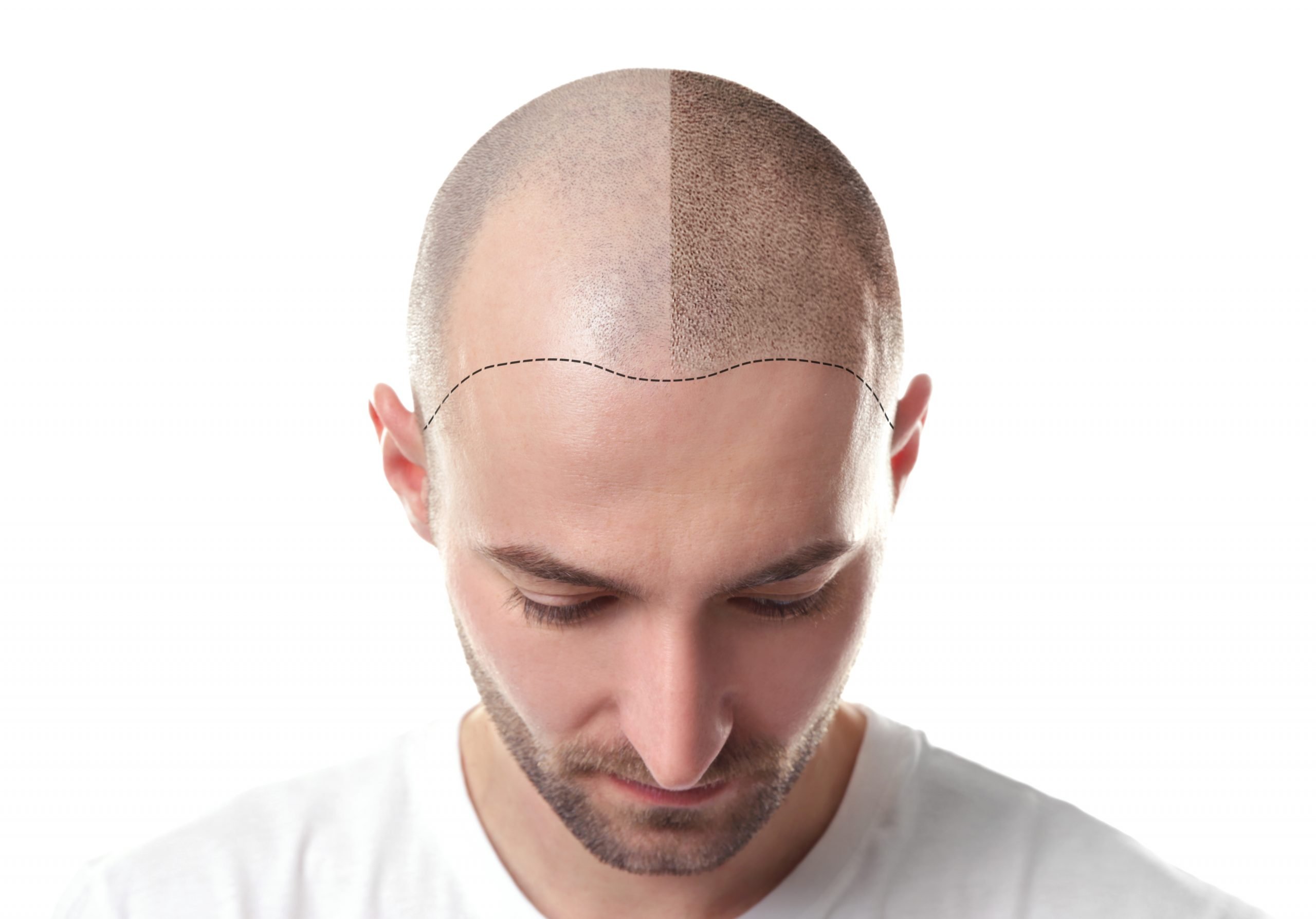 Scalp Micro-Pigmentation Is Becoming A Popular Way To Add Volume And Definition