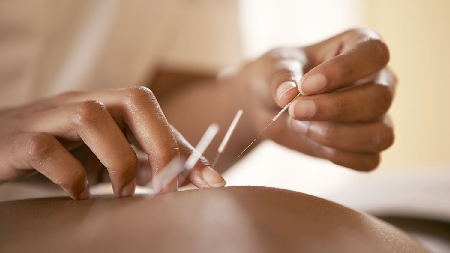 What to Know Before Choosing an Acupuncture Clinic