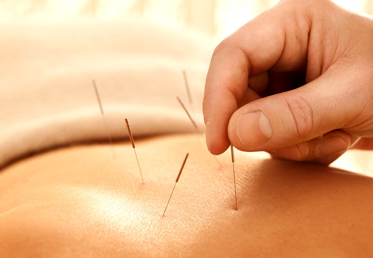 What Is The Best Acupuncturist?