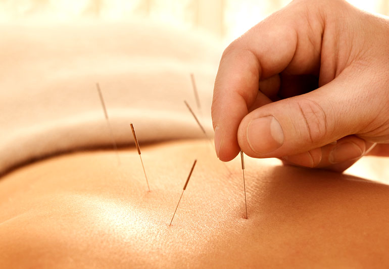 best acupuncture