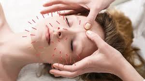 What is Acupuncture Melbourne?