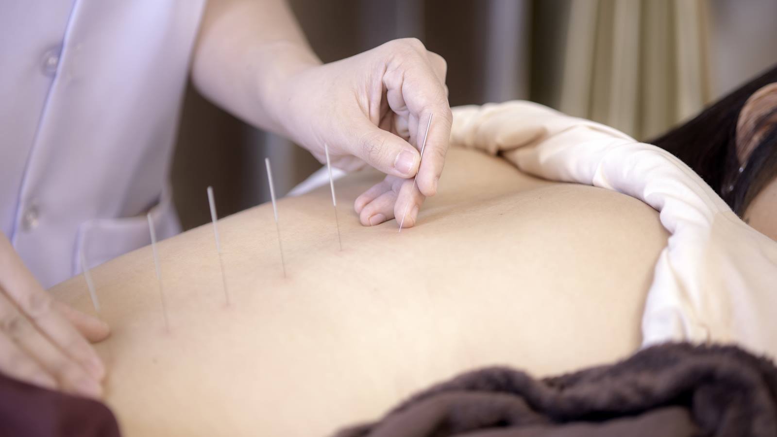 Acupuncture Melbourne