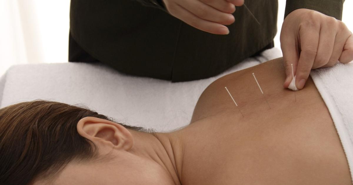 acupuncture Melbourne CBD